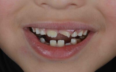 Qué hacer con un diente roto: Guía de atención dental